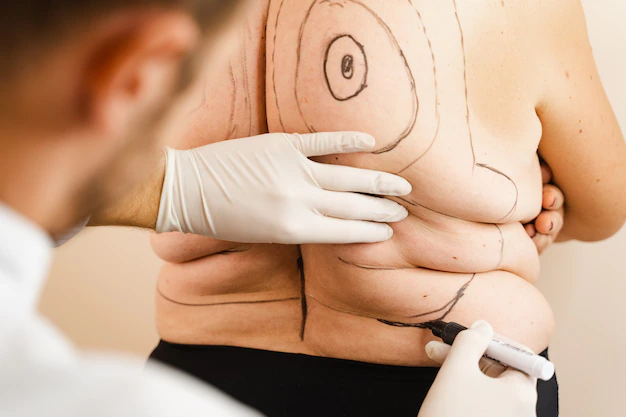 liposuction