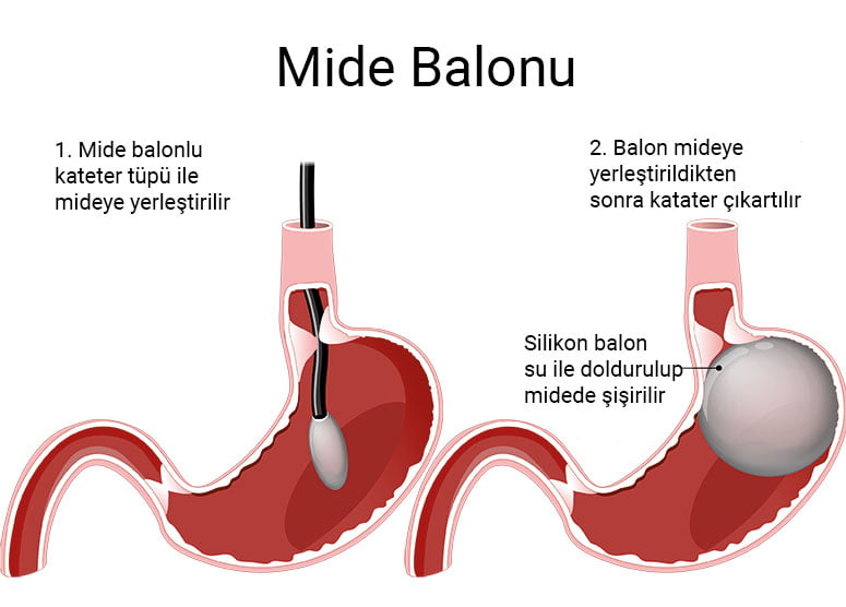 mide-balonu