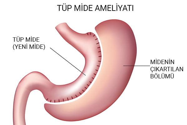 tüp mide